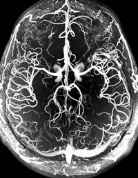 Michaela’s Fluent Aphasia by Christina Carrafiell